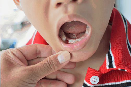 Children Dental Care in Emergency