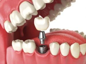 Dental Implants Sutherland