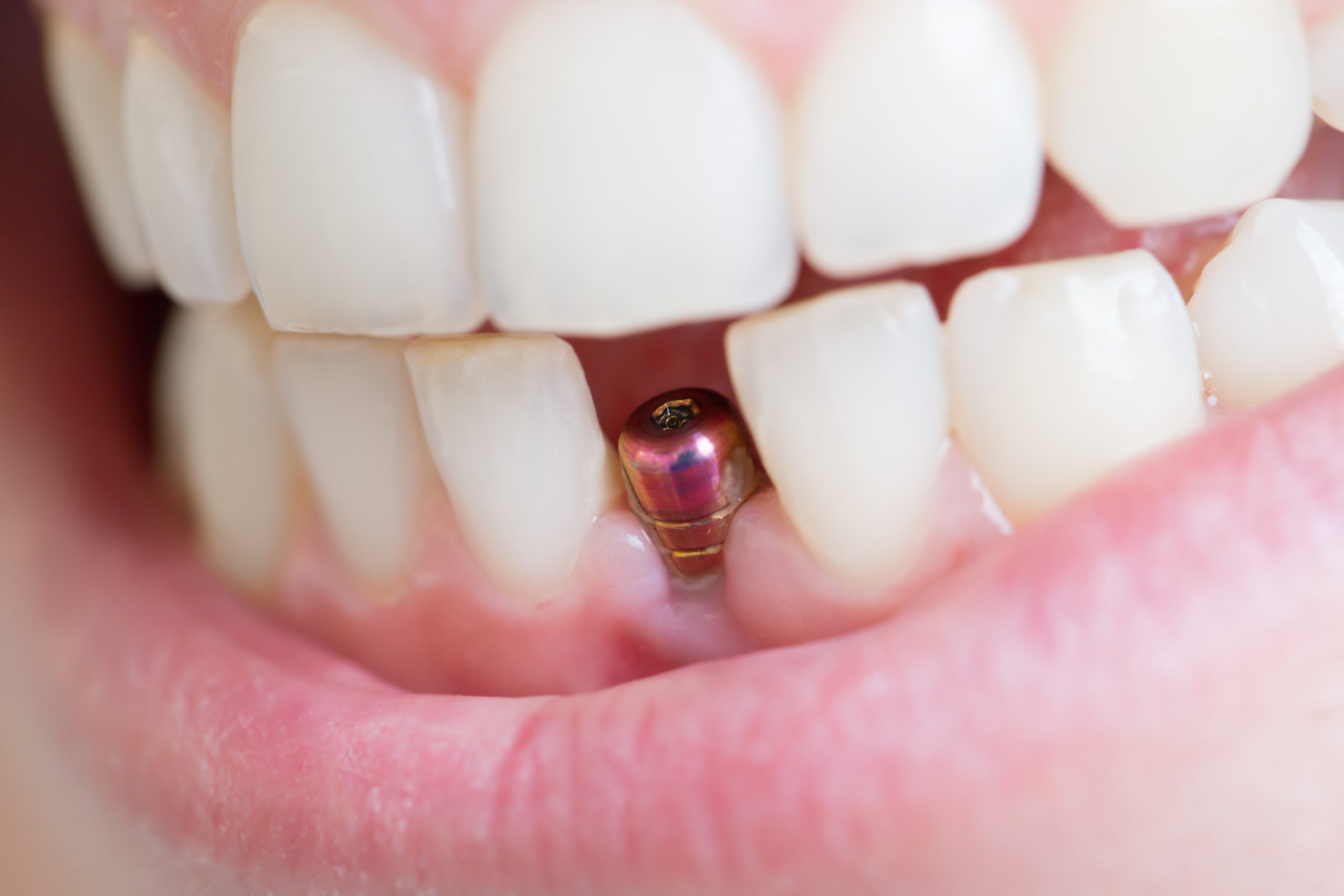 Dental implant to replace missing tooth