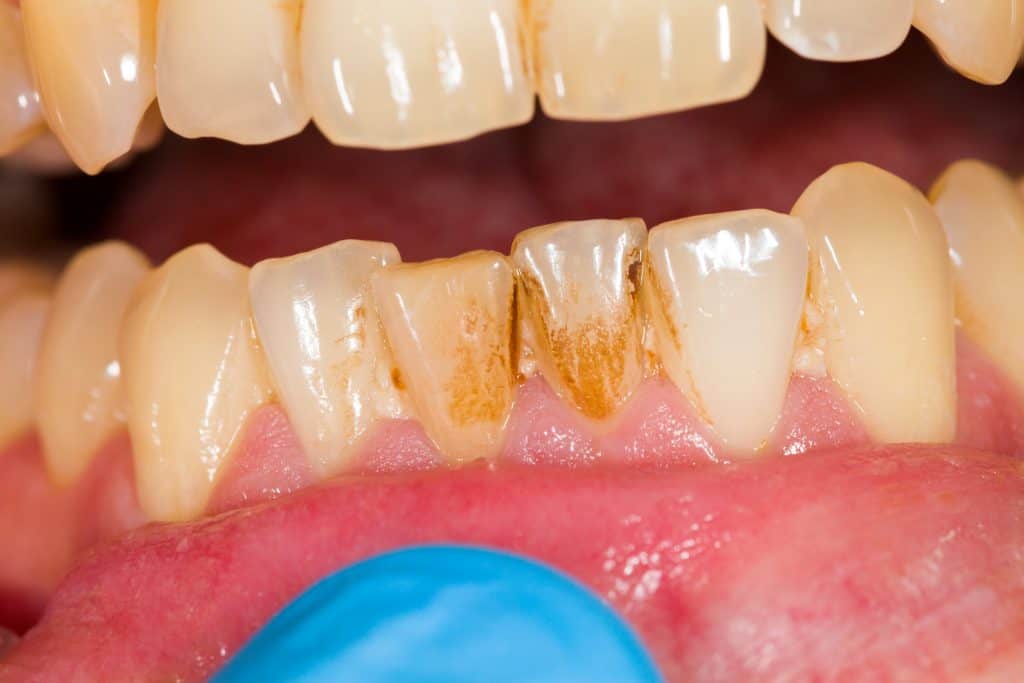 Plaque clearance on teeth