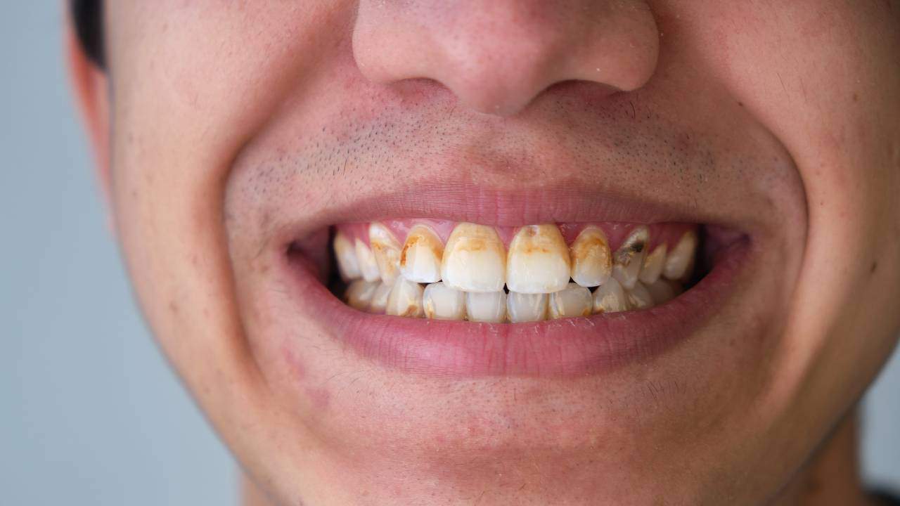 tartar buildup on teeth