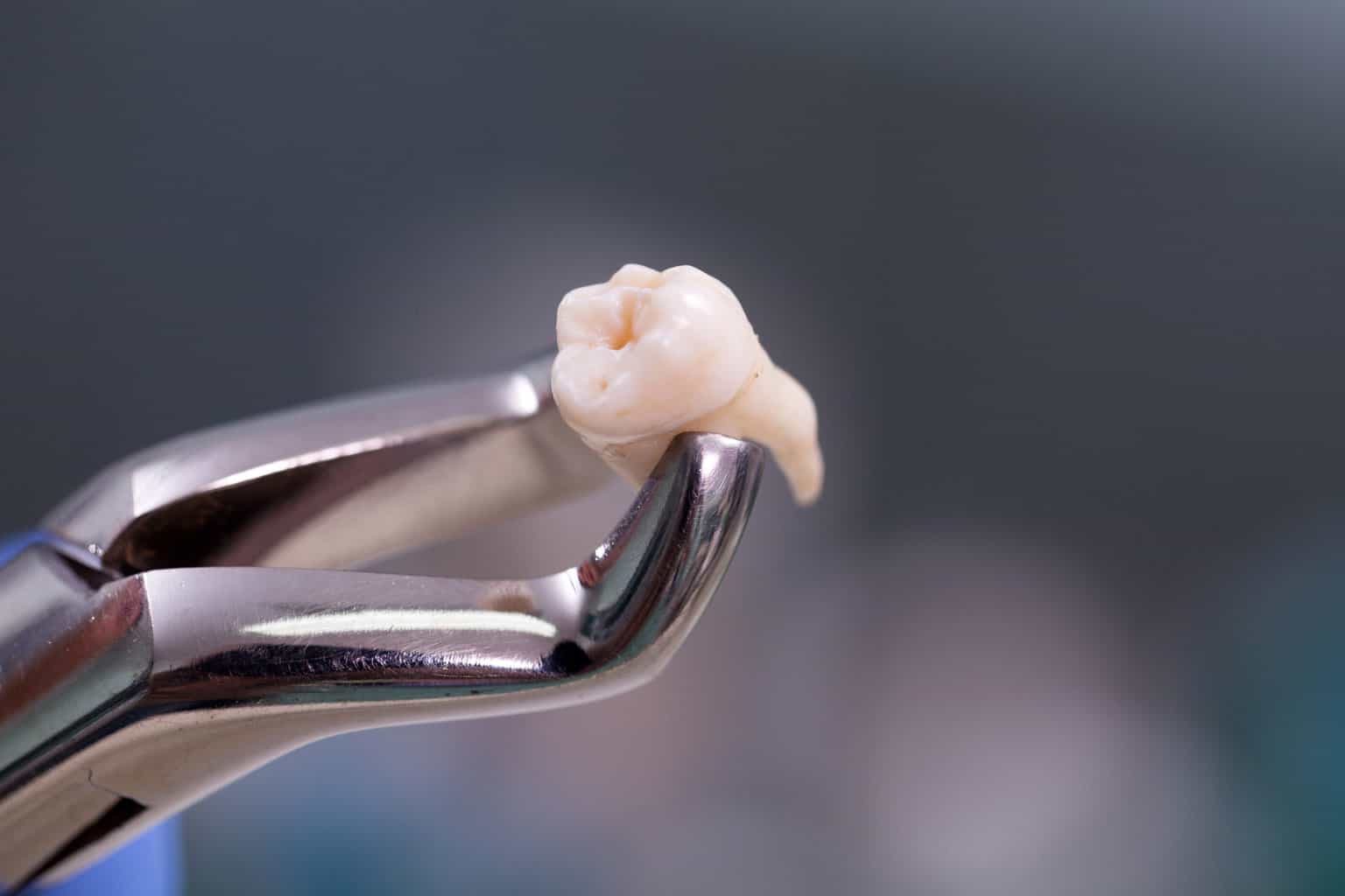 Wisdom Teeth Removal – Cost And Procedures