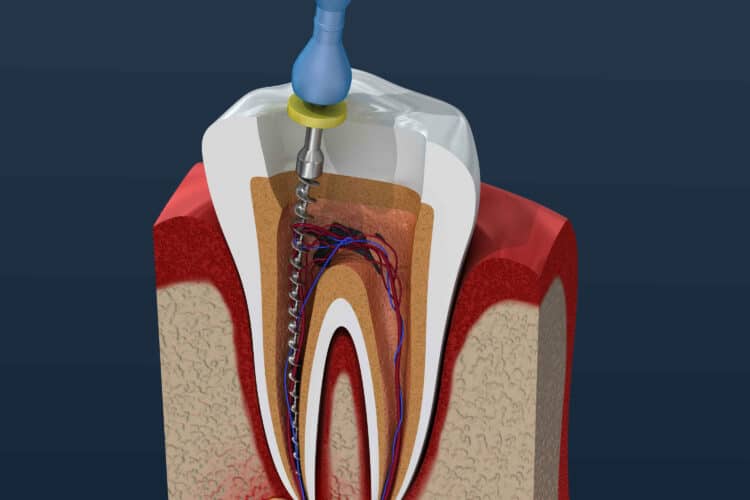 How Much Does the Root Canal Cost in Australia
