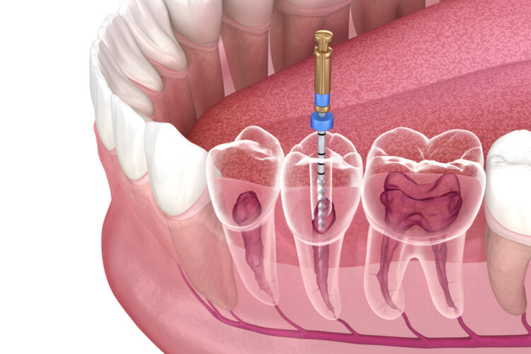 Root Canal Durability: Is it a Long-term Solution?