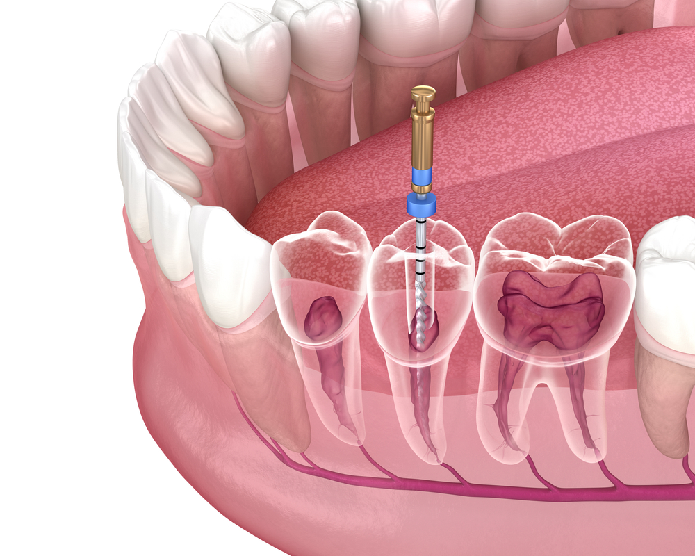Root Canal Durability: Is it a Long-term Solution?