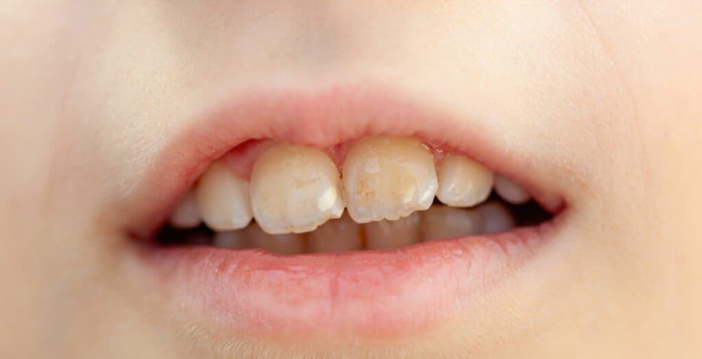 Infant Bruxism , Infant bruxism causes, Baby teeth grinding, Bruxism in infants, Teeth grinding in babies, Infant jaw clenching, Symptoms of infant bruxism, Managing baby bruxism, Causes of infant teeth grinding