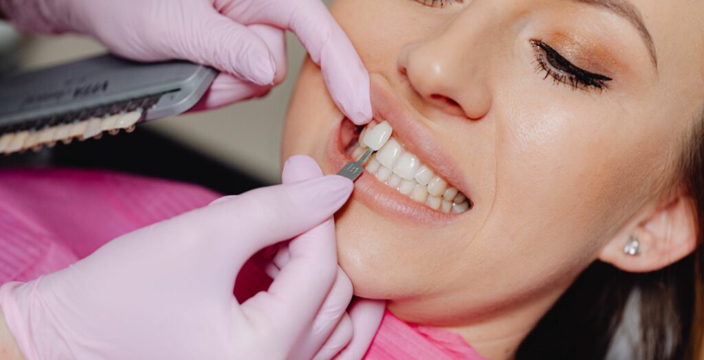 Porcelain veneers, Dental veneers, Cosmetic dentistry veneers, Teeth veneers procedure, Porcelain veneers before and after, Smile makeover, Veneers for chipped teeth, Veneers for stained teeth, Dental veneer treatment, Porcelain veneer application, Veneers for perfect smile, Cosmetic tooth restoration, Durable porcelain veneers